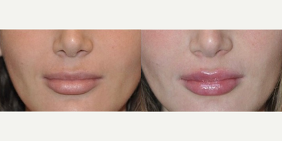 Case 7307 - Woman treated with Lip Fillers