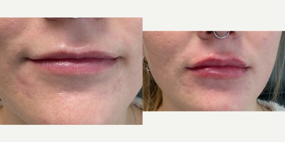 Case 7308 - 18-24 year old woman treated with Lip Fillers