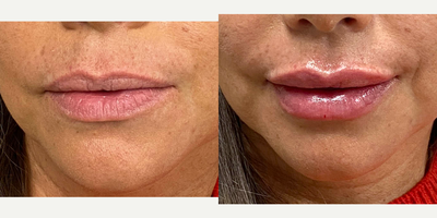 Case 7309 - 45-54 year old woman treated with Lip Fillers