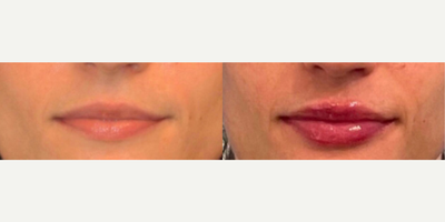 Case 7310 - Woman treated with Lip Fillers