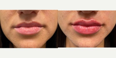 Case 7311 - 25-34 year old woman treated with Lip Fillers