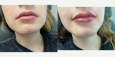 Case 7312 - 18-24 year old woman treated with Lip Fillers