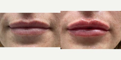 Case 7321 - 25-34 year old woman treated with Lip Fillers