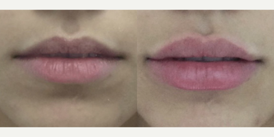Case 7322 - 18-24 year old woman treated with Lip Fillers