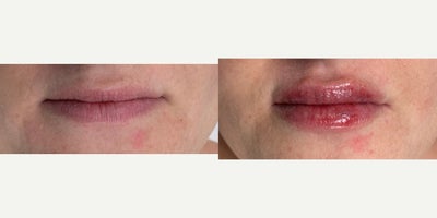 Case 7323 - 25-34 year old woman treated with Lip Fillers