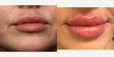 Case 7324 - 35-44 year old woman treated with Lip Fillers