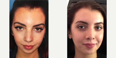 Case 7325 - Woman treated with Lip Fillers