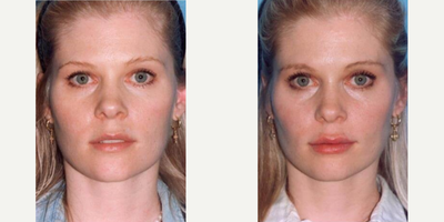 Case 7326 - Woman treated with Lip Fillers