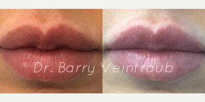 Case 7327 - Woman treated with Lip Augmentation