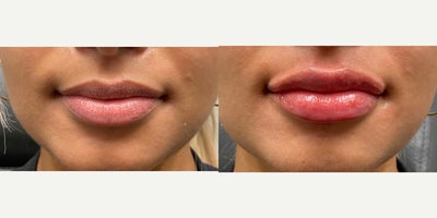 Case 7328 - 18-24 year old woman treated with Lip Augmentation