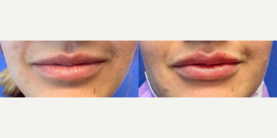 Case 7329 - Woman treated with Lip Augmentation