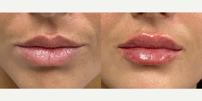 Case 7330 - 25-34 year old woman treated with Lip Augmentation