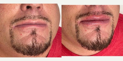 Case 7331 - 45-54 year old man treated with Lip Augmentation