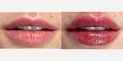 Case 7332 - 25-34 year old woman treated with Lip Augmentation