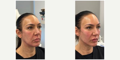 Case 7333 - 45-54 year old woman treated with Dermal Fillers, Lip Fillers