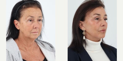 Case 7334 - 55-64 year old woman treated with Facelift, Neck Lift, Brow Lift, Eyelid Surgery, Facial Fat Transfer, CO2 Laser, Lip Fillers