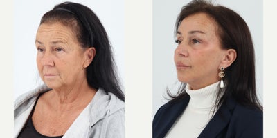 Case 7335 - 55-64 year old woman treated with Facelift, Neck Lift, Brow Lift, Eyelid Surgery, Facial Fat Transfer, CO2 Laser, Lip Fillers