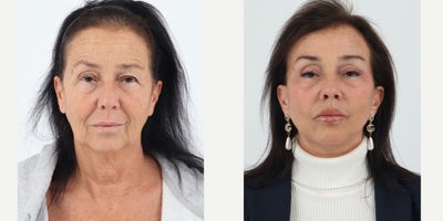 Case 7336 - 55-64 year old woman treated with Facelift, Neck Lift, Brow Lift, Eyelid Surgery, Facial Fat Transfer, CO2 Laser, Lip Fillers