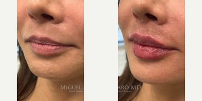 Case 7337 - Woman treated with Lip Fillers