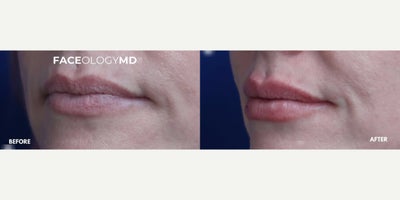 Case 7338 - Woman treated with Lip Fillers
