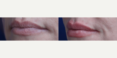 Case 7339 - Woman treated with Lip Fillers