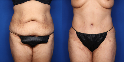 Case 734 - 35-44 year old woman treated with Tummy Tuck