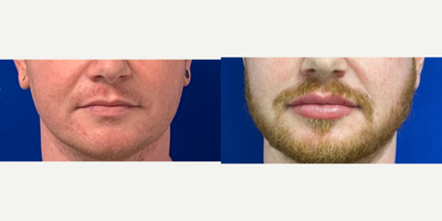 Case 7342 - 25-34 year old man treated with Lip Augmentation