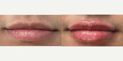 Case 7343 - 18-24 year old woman treated with Lip Augmentation