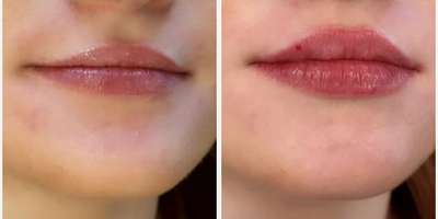 Case 7344 - Woman treated with Lip Fillers