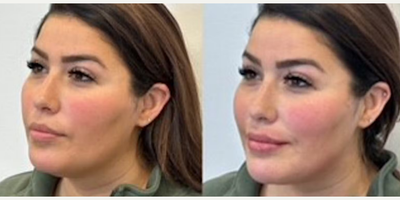 Case 7345 - Woman treated with Lip Fillers