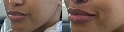 Case 7346 - Woman treated with Lip Fillers