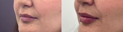 Case 7347 - Woman treated with Lip Fillers