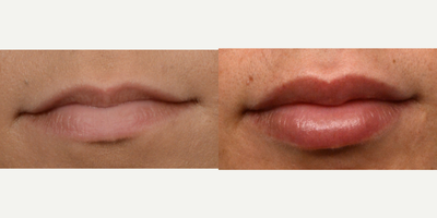 Case 7348 - 25-34 year old woman treated with Lip Augmentation