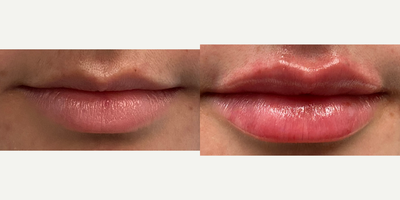 Case 7349 - 18-24 year old woman treated with Lip Augmentation