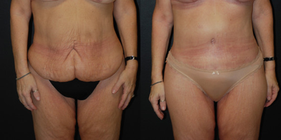 Case 735 - 52 year old woman treated with Tummy Tuck