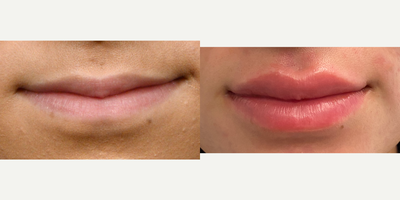 Case 7350 - 18-24 year old woman treated with Lip Augmentation