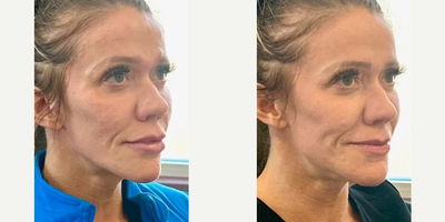 Case 7351 - Woman treated with Voluma, Juvederm, Lip Fillers