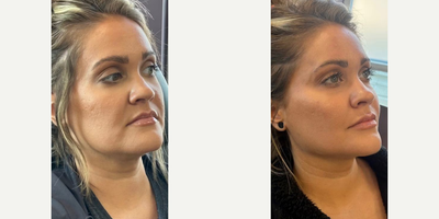 Case 7352 - Woman treated with Dermal Fillers, Lip Fillers