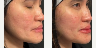 Case 7353 - Woman treated with Juvederm, Lip Fillers