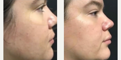 Case 7354 - Woman treated with Lip Fillers, Juvederm