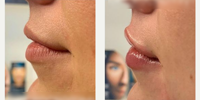 Case 7355 - Woman treated with Lip Fillers, Juvederm