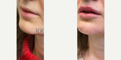 Case 7356 - Woman treated with Lip Fillers