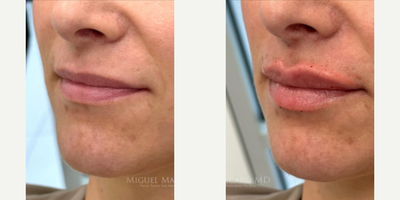 Case 7357 - Woman treated with Lip Fillers