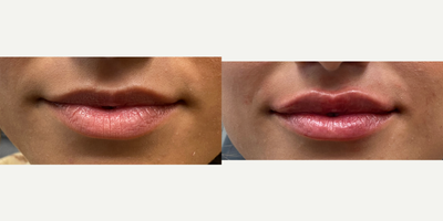 Case 7358 - 18-24 year old woman treated with Lip Augmentation