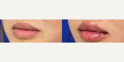 Case 7359 - Woman treated with Lip Fillers