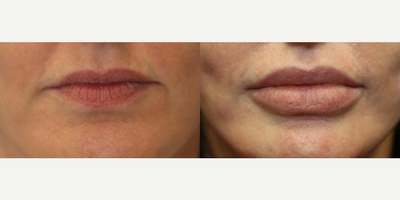 Case 7360 - Lip Augmentation