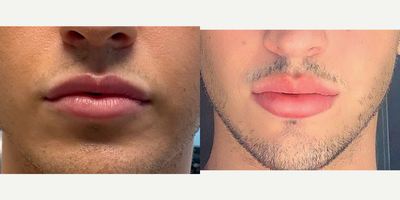 Case 7361 - 25-34 year old man treated with Lip Augmentation