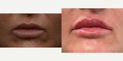 Case 7362 - 45-54 year old woman treated with Lip Augmentation