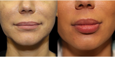 Case 7363 - Woman treated with Lip Fillers