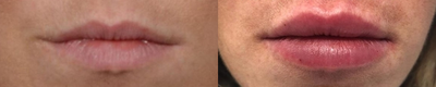 Case 7364 - Lip Augmentation